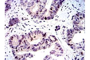 Immunohistochemical analysis of paraffin-embedded colon cancer tissues using BIRC5 mouse mAb with DAB staining. (Survivin 抗体)