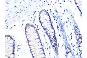 Immunohistochemistry of paraffin-embedded human colon using MT Rabbit mAb (ABIN1679683, ABIN7101713, ABIN7101714 and ABIN7101715) at dilution of 1:100 (40x lens). (MTA2 抗体)