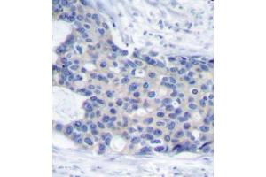 Immunohistochemistry of paraffin-embedded human breast carcinoma tissue, using Phospho-ZAP70-Y493 antibody (ABIN2988352). (ZAP70 抗体  (pTyr493))