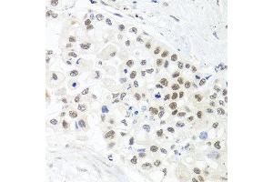 Immunohistochemistry of paraffin-embedded human lung cancer using TRMT1 antibody at dilution of 1:100 (x40 lens). (TRMT1 抗体)