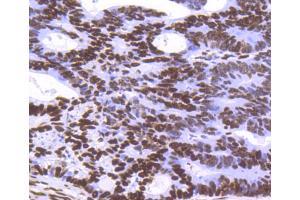 Paraformaldehyde-fixed, paraffin embedded Human breast carcinoma tissue, Antigen retrieval by boiling in sodium citrate buffer (pH6) for 15min, Block endogenous peroxidase by 3% hydrogen peroxide for 30 minutes, Blocking buffer at 37°C for 20min, Antibody incubation with Histone H3. (Histone H3.3 抗体)