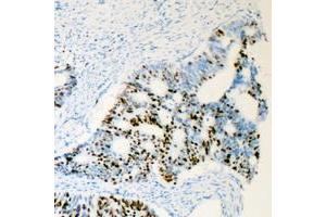 Immunohistochemical analysis of Androgen Receptor (pS650) staining in human prostate cancer formalin fixed paraffin embedded tissue section. (Androgen Receptor 抗体  (pSer650))