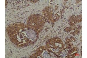 Immunohistochemical analysis of paraffin-embedded Human Breast Carcinoma using P44/42 MAPK (ERK1/2) Mouse mAb diluted at 1:200. (ERK1/2 抗体)