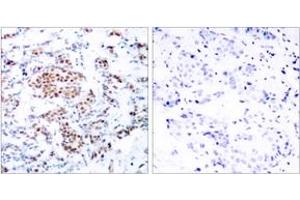 Immunohistochemistry analysis of paraffin-embedded human breast carcinoma tissue, using STAT5A (Ab-694) Antibody. (STAT5A 抗体  (AA 666-715))