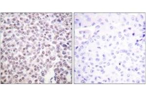 Immunohistochemistry analysis of paraffin-embedded human breast carcinoma tissue, using Histone H2B (Ab-5) Antibody. (Histone H2B 抗体  (AA 1-50))