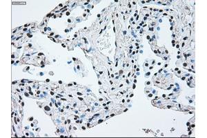 Immunohistochemical staining of paraffin-embedded Adenocarcinoma of breast tissue using anti-BRAF mouse monoclonal antibody. (BRAF 抗体)