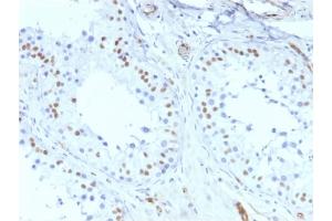 Immunohistochemistry (IHC) image for anti-Wilms Tumor 1 (WT1) antibody (ABIN6940904)