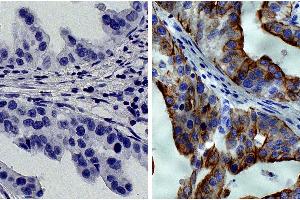 Paraffin embedded human gastric cancer tissue was stained with Mouse IgG2a-HRP isotype control followed by DAB and hematoxylin. (KRT8 抗体  (HRP))