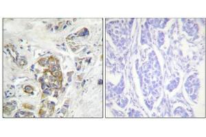 Immunohistochemical analysis of paraffin-embedded human breast carcinoma tissue, using ITGB4 (Phospho-Tyr1510) antibody (left)or the same antibody preincubated with blocking peptide (right). (Integrin beta 4 抗体  (pTyr1510))