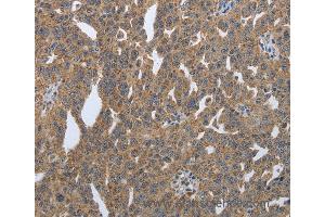 Immunohistochemistry of Human lung cancer using PDIA2 Polyclonal Antibody at dilution of 1:50 (PDIA2 抗体)