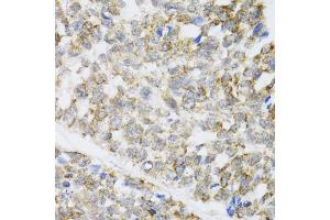 Immunohistochemistry of paraffin-embedded human esophageal cancer using ZAK antibody (ABIN6133445, ABIN6150360, ABIN6150361 and ABIN6223229) at dilution of 1:100 (40x lens). (ZAK 抗体  (AA 1-330))