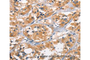 Immunohistochemistry of Human cervical cancer using AHR Polyclonal Antibody at dilution of 1:50 (Aryl Hydrocarbon Receptor 抗体)
