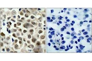 Immunohistochemistry analysis of paraffin-embedded human lung carcinoma, using HDAC8 (Phospho-Ser39) Antibody. (HDAC8 抗体  (pSer39))