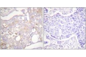 Immunohistochemistry analysis of paraffin-embedded human breast carcinoma tissue, using Claudin 4 Antibody. (Claudin 4 抗体  (AA 160-209))
