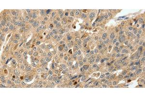 Immunohistochemistry of paraffin-embedded Human ovarian cancer tissue using S100A4 Polyclonal Antibody at dilution 1:80 (s100a4 抗体)