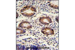 Formalin-fixed and paraffin-embedded human colon carcinoma with CLNS1A Antibody , which was peroxidase-conjugated to the secondary antibody, followed by DAB staining. (CLNS1A 抗体  (C-Term))