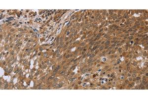 Immunohistochemistry of paraffin-embedded Human cervical cancer using NDUFS2 Polyclonal Antibody at dilution of 1:35 (NDUFS2 抗体)