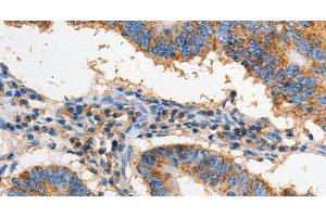 Immunohistochemistry of paraffin-embedded Human colon cancer using FAS Polyclonal Antibody at dilution of 1:60 (FAS 抗体)