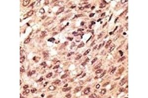 IHC analysis of FFPE human hepatocarcinoma stained with the LRP5 antibody (LRP5 抗体  (AA 1538-1567))