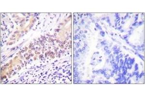Immunohistochemistry analysis of paraffin-embedded human lung carcinoma tissue, using TOP2B Antibody. (TOP2B 抗体  (AA 1-50))