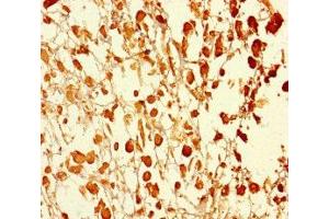 Immunohistochemistry of paraffin-embedded human melanoma using ABIN7174595 at dilution of 1:100 (UBXN2B 抗体  (AA 2-250))