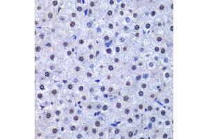 Immunohistochemistry of paraffin-embedded human liver cancer using GSTP1 antibody at dilution of 1:200 (400x lens). (GSTP1 抗体)