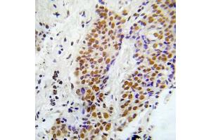 Immunohistochemical analysis of paraffin-embedded human lung adenocarcinoma tissue using ASK1 (Phospho-Ser966) Antibody (E012059). (ASK1 抗体  (pSer966))