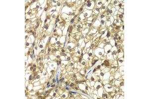 Immunohistochemistry of paraffin-embedded human kidney cancer using SULT2B1 antibody at dilution of 1:100 (x40 lens). (SULT2B1 抗体)