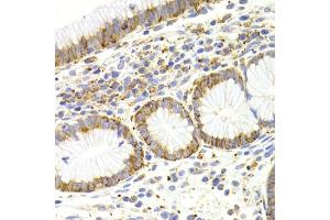 Immunohistochemistry of paraffin-embedded human gastric cancer using KISS1R Antibody (ABIN5971525) at dilution of 1/200 (40x lens). (KISS1R 抗体)