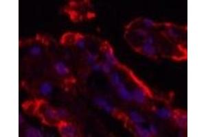 Immunofluorescence analysis of Human lung cancer tissue using Galectin 3 Monoclonal Antibody at dilution of 1:200. (Galectin 3 抗体)