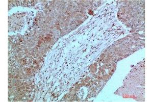 Immunohistochemical analysis of paraffin-embedded Human Breast Carcinoma Tissue using JAK2 Mouse mAb diluted at 1:2000 (JAK2 抗体)