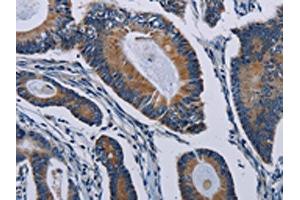 The image on the left is immunohistochemistry of paraffin-embedded Human colon cancer tissue using ABIN7191806(PCDHAC2 Antibody) at dilution 1/50, on the right is treated with synthetic peptide. (PCDHAC2 抗体)