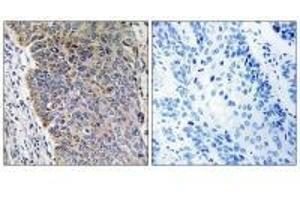 Immunohistochemistry analysis of paraffin-embedded human lung carcinoma tissue using MGST3 antibody. (MGST3 抗体)