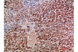 Immunohistochemical analysis of paraffin-embedded human-liver-cancer, antibody was diluted at 1:200. (GDF2 抗体  (AA 371-420))