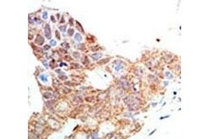 IHC analysis of FFPE human breast carcinoma tissue stained with the PRMT5 antibody (PRMT5 抗体  (AA 591-621))