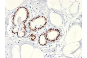 Formalin-fixed, paraffin-embedded human Breast Carcinoma stained with Estrogen Receptor, alpha Rabbit Recombinant Monoclonal Antibody (ESR1/2299R). (Recombinant Estrogen Receptor alpha 抗体)