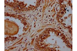 IHC image of ABIN7164923 diluted at 1:600 and staining in paraffin-embedded human prostate cancer performed on a Leica BondTM system. (PSME4 抗体  (AA 105-198))