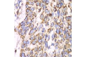 Immunohistochemistry of paraffin-embedded human esophageal cancer using ATP5A1 antibody. (ATP5A1 抗体)