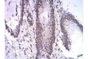 Immunohistochemical analysis of paraffin-embedded colon cancer tissues using ASH2L mouse mAb with DAB staining. (ASH2L 抗体  (AA 493-628))