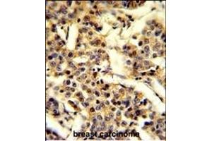Formalin-fixed and paraffin-embedded human breast carcinoma reacted with CYP2A13 Antibody (C-term), which was peroxidase-conjugated to the secondary antibody, followed by DAB staining. (CYP2A13 抗体  (C-Term))