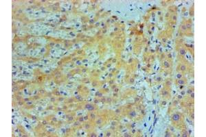 Immunohistochemical of paraffin-embedded Human live cancer tissue using ABIN7156047 at dilution of 1:200. (IL1A 抗体)