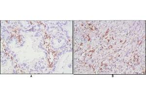 Immunohistochemical analysis of paraffin-embedded human lung cancer (A), lymphonodus tissue (B),showing cytomembrane localization using CD38 mouse mAb with DAB staining. (CD38 抗体)