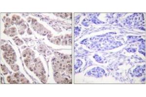 Immunohistochemistry analysis of paraffin-embedded human breast carcinoma tissue, using Histone H4 (Ab-5) Antibody. (Histone H4 抗体  (AA 1-50))
