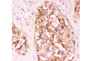 IHC-P: Crk antibody testing of human lung cancer tissue (Crk 抗体  (AA 2-246))