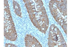 Immunohistochemistry (IHC) image for anti-Epithelial Cell Adhesion Molecule (EPCAM) (AA 100-224), (Extracellular Domain) antibody (ABIN6939997)