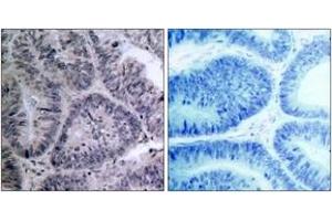 Immunohistochemistry analysis of paraffin-embedded human colon carcinoma tissue, using IKK-alpha (Ab-23) Antibody. (IKK alpha 抗体  (AA 15-64))
