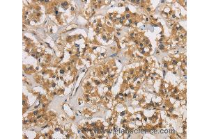 Immunohistochemistry of Human thyroid cancer using CASP3 Polyclonal Antibody at dilution of 1:30 (Caspase 3 抗体)