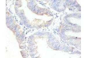 Immunohistochemistry of paraffin-embedded human endometrial cancer using ABIN7164742 at dilution of 1:100 (Ki-67 抗体  (AA 3120-3256))