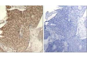 Immunohistochemical analysis of paraffin-embedded human breast carcinoma tissue using HDAC2 (Phospho- Ser394) antibody (E011191). (HDAC2 抗体  (pSer394))