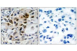 Immunohistochemical analysis of paraffin-embedded human lung carcinoma tissue, using AFX (Ab-197) antibody (E0 21162 ). (FOXO4 抗体)